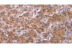 Immunohistochemistry of paraffin-embedded Human gastic cancer using HMGCS1 Polyclonal Antibody at dilution of 1:40 (HMGCS1 抗体)