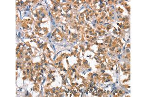 Immunohistochemistry of Human gastric cancer using HGF Polyclonal Antibody at dilution of 1:65 (HGF 抗体)