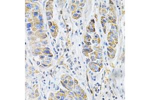 Immunohistochemistry of paraffin-embedded human liver cancer using VAPB Antibody (ABIN1876551) at dilution of 1:200 (40x lens). (VAPB 抗体)
