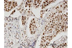 Immunoperoxidase of monoclonal antibody to PBK on formalin-fixed paraffin-embedded human cholangiocarcinoma. (PBK 抗体  (AA 1-30))