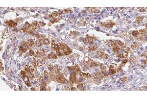 ABIN6279753 at 1/100 staining Human liver cancer tissue by IHC-P. (PTPRK 抗体  (Internal Region))