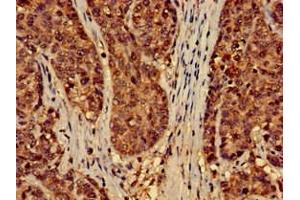Immunohistochemistry of paraffin-embedded human ovarian cancer using ABIN7151428 at dilution of 1:100 (EFHD2 抗体  (AA 2-240))