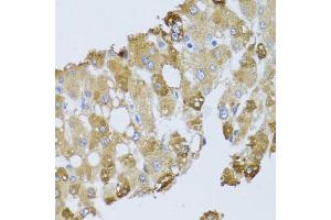 Immunohistochemistry of paraffin-embedded human liver injury using BNIP3 antibody. (BNIP3 抗体)
