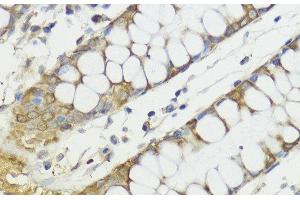 Immunohistochemistry of paraffin-embedded Human colon using HACE1 Polyclonal Antibody at dilution of 1:100 (40x lens).