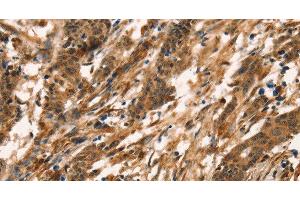 Immunohistochemistry of paraffin-embedded Human gastric cancer tissue using CD159a/c Polyclonal Antibody at dilution 1:30 (CD159a/c 抗体)