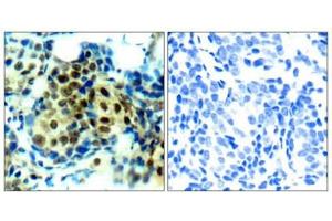 Immunohistochemical analysis of paraffin-embedded human breast carcinoma tissue using p44/42 MAP Kinase (Phospho-Thr202) Antibody (left) or the same antibody preincubated with blocking peptide (right). (ERK1 抗体  (pThr202))
