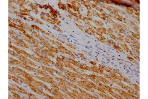 IHC image of ABIN7127818 diluted at 1:100 and staining in paraffin-embedded human liver cancer performed on a Leica BondTM system.