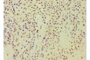 Immunohistochemistry of paraffin-embedded human breast cancer using ABIN7143446 at dilution of 1:100 (ARF3 抗体  (AA 1-181))