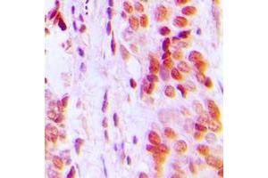 Immunohistochemical analysis of p57 Kip2 staining in human breast cancer formalin fixed paraffin embedded tissue section. (CDKN1C 抗体  (N-Term))