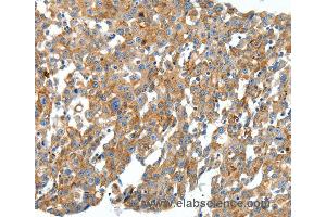 Immunohistochemistry of Human cervical cancer using CXCL12 Polyclonal Antibody at dilution of 1:40 (CXCL12 抗体)