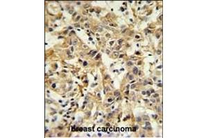 CA6 Antibody (C-term) (ABIN653737 and ABIN2843041) IHC analysis in formalin fixed and paraffin embedded breast carcinoma followed by peroxidase conjugation of the secondary antibody and DAB staining. (CA6 抗体  (C-Term))