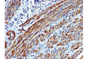 Formalin-fixed, paraffin-embedded human Leiomyosarcoma stained with SM-MHC Mouse Monoclonal Antibody (MYH11/923). (MYH11 抗体)