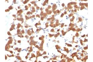 Formalin-fixed, paraffin-embedded human Thyroid Carcinoma stained with Cytokeratin 18 Mouse Monoclonal Antibody (C-04). (Cytokeratin 18 抗体)