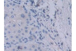 Detection of YARS in Human Liver cancer Tissue using Polyclonal Antibody to Tyrosyl tRNA Synthetase (YARS) (YARS 抗体  (AA 2-528))
