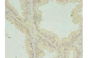 Immunohistochemistry of paraffin-embedded human prostate cancer using ABIN7147106 at dilution of 1:100 (RQCD1 抗体  (AA 1-258))
