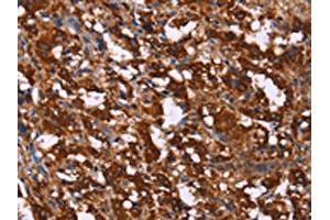 The image on the left is immunohistochemistry of paraffin-embedded Human thyroid cancer tissue using ABIN7190739(GAGE12I Antibody) at dilution 1/20, on the right is treated with synthetic peptide. (G Antigen 12I 抗体)