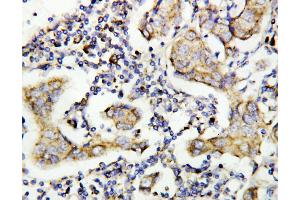 Anti-Caspase-8(P10) antibody, IHC(P) IHC(P): Human Mammary Cancer Tissue (Caspase 8 抗体  (C-Term))