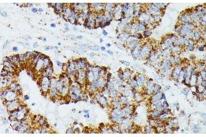 Immunohistochemistry of paraffin-embedded Human colon carcinoma using ETHE1 Polyclonal Antibody at dilution of 1:100 (40x lens). (ETHE1 抗体)