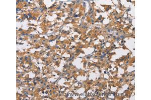 Immunohistochemistry of Human liver cancer using NT5E Polyclonal Antibody at dilution of 1:50 (CD73 抗体)