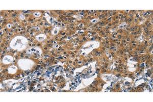 Immunohistochemistry of paraffin-embedded Human gasrtic cancer tissue using DCC Polyclonal Antibody at dilution 1:70 (DCC 抗体)