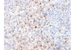 Formalin-fixed, paraffin-embedded Melanoma stained with Tyrosinase Rabbit Recombinant Monoclonal Antibody (TYR/2024R). (Recombinant TYR 抗体)