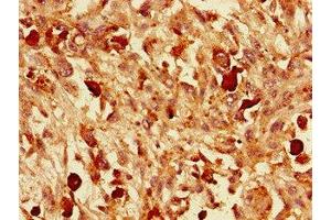 Immunohistochemistry of paraffin-embedded human melanoma using ABIN7161441 at dilution of 1:100 (VGF 抗体  (AA 23-206))