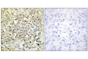Immunohistochemistry analysis of paraffin-embedded human lung carcinoma tissue using CDKL4 antibody. (CDKL4 抗体  (C-Term))