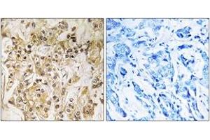 Immunohistochemistry analysis of paraffin-embedded human breast carcinoma tissue, using ZNF295 Antibody. (ZNF295 抗体  (AA 731-780))