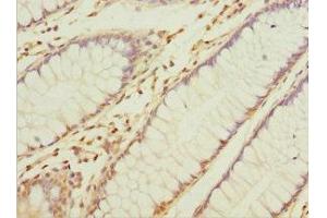 Immunohistochemistry of paraffin-embedded human colon cancer using ABIN7153563 at dilution of 1:100 (NAPG 抗体  (AA 1-312))
