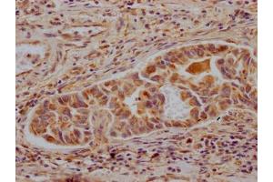 IHC image of ABIN7127333 diluted at 1:100 and staining in paraffin-embedded human liver cancer performed on a Leica BondTM system. (Recombinant ALDH2 抗体)