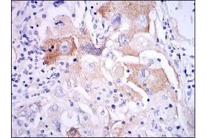 Immunohistochemical analysis of paraffin-embedded lung cancer tissues using IL1B mouse mAb with DAB staining. (IL-1 beta 抗体)