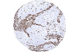 Larynx Strong vimentin positivity of the tumor stroma in a squamous cell carcinoma