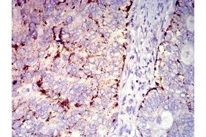Immunohistochemical analysis of paraffin-embedded cervical cancer tissues using CD182 mouse mAb with DAB staining. (CXCR2 抗体)