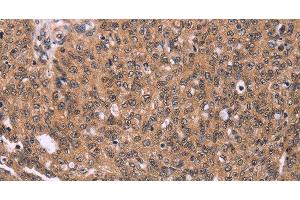 Immunohistochemistry of paraffin-embedded Human ovarian cancer using ERAS Polyclonal Antibody at dilution of 1:40 (ERAS 抗体)