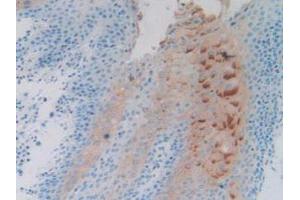 IHC-P analysis of Human Stomach Cancer Tissue, with DAB staining. (PTPRH 抗体  (AA 844-1096))