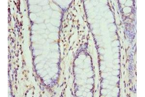 Immunohistochemistry of paraffin-embedded human colon cancer using ABIN7161336 at dilution of 1:100 (Neuromedin U 抗体  (AA 35-174))