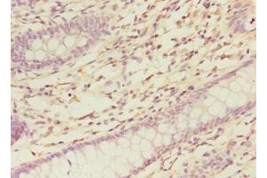 Immunohistochemistry of paraffin-embedded human colon cancer using ABIN7161139 at dilution of 1:100 (COBRA1 抗体  (AA 8-199))