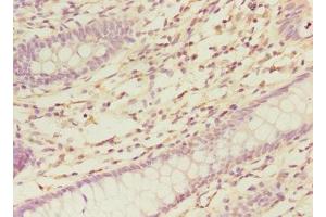 Immunohistochemistry of paraffin-embedded human colon cancer using ABIN7161139 at dilution of 1:100 (COBRA1 抗体  (AA 8-199))
