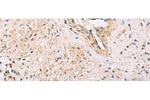 Immunohistochemistry of paraffin-embedded Human prost ate cancer tissue using PCYT2 Polyclonal Antibody at dilution of 1:55(x200) (PCYT2 抗体)