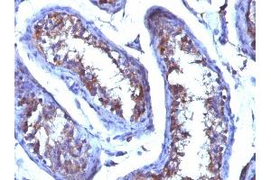 Formalin-fixed, paraffin-embedded human Testicular Carcinoma stained with Testosterone Mouse Monoclonal Antibody (4E1G2). (Testosterone 抗体)