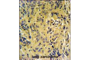 TESC Antibody IHC analysis in formalin fixed and paraffin embedded human lung carcinoma followed by peroxidase conjugation of the secondary antibody and DAB staining. (Tescalcin 抗体  (C-Term))