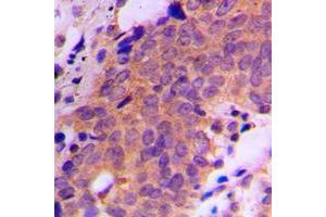 Immunohistochemical analysis of USP19 staining in human breast cancer formalin fixed paraffin embedded tissue section. (USP19 抗体  (Center))