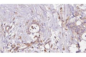 ABIN6273043 at 1/100 staining Human liver cancer tissue by IHC-P. (ERO1LB 抗体  (Internal Region))