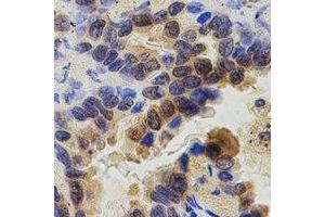 Immunohistochemical analysis of ZAP70 staining in human lung cancer formalin fixed paraffin embedded tissue section. (ZAP70 抗体  (C-Term))