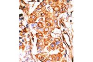 Formalin-fixed and paraffin-embedded human cancer tissue reacted with the primary antibody, which was peroxidase-conjugated to the secondary antibody, followed by AEC staining. (GK2 抗体  (C-Term))