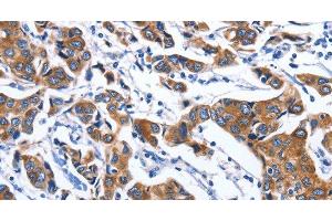 Immunohistochemistry of paraffin-embedded Human breast cancer tissue using MYH1 Polyclonal Antibody at dilution 1:40 (MYH1 抗体)