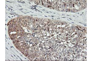 Immunohistochemical staining of paraffin-embedded Adenocarcinoma of Human ovary tissue using anti-ASCC1 mouse monoclonal antibody. (ASCC1 抗体)