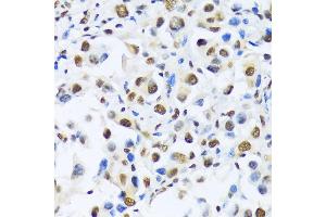 Immunohistochemistry of paraffin-embedded human lung cancer using OTP antibody (ABIN6132447, ABIN6145083, ABIN6145084 and ABIN6217092) at dilution of 1:100 (40x lens). (OTP 抗体  (AA 1-130))