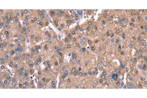 Immunohistochemistry of paraffin-embedded Human liver cancer tissue using SPAST Polyclonal Antibody at dilution 1:40