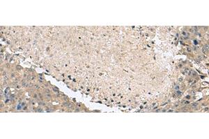 Immunohistochemistry of paraffin-embedded Human liver cancer tissue using KCTD7 Polyclonal Antibody at dilution of 1:55(x200) (KCTD7 抗体)